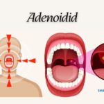 Adenoidid