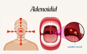 Adenoidid